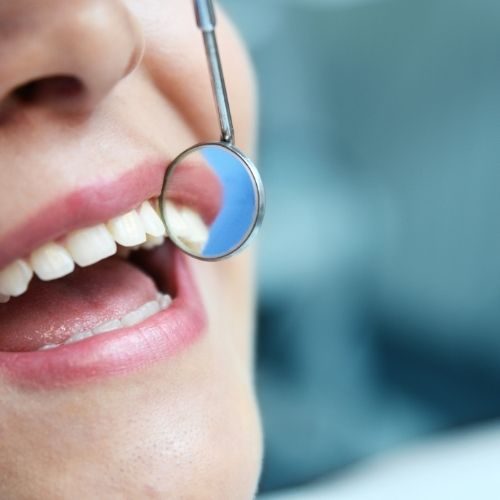 RIPARAZIONE denti